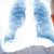 Propagación del cáncer de pulmón hacia los ganglios linfáticos